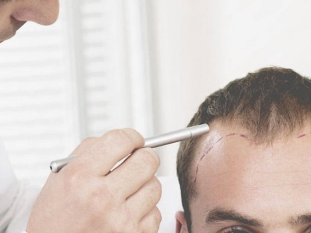 Recovery Tips For a Hair Transplant