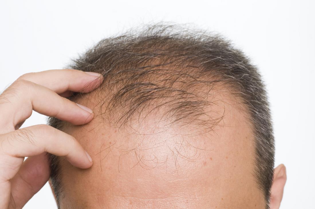 Hair Transplant Surgery Pros and Cons