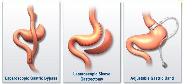 Bariatric Surgery Types
