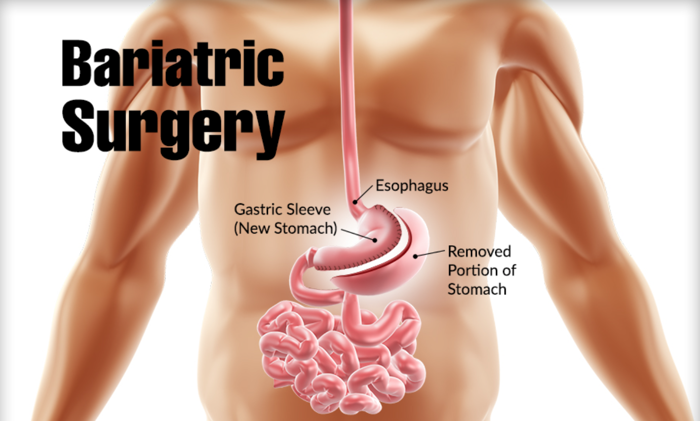 Bariatric Surgery in Pune- All You Need To Know