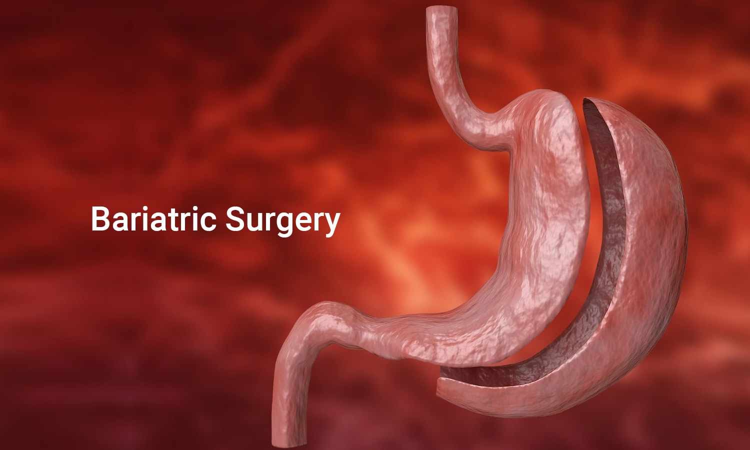 Benefits Of Bariatric Weightloss Surgery – Explained by Dr. Harsh Seth
