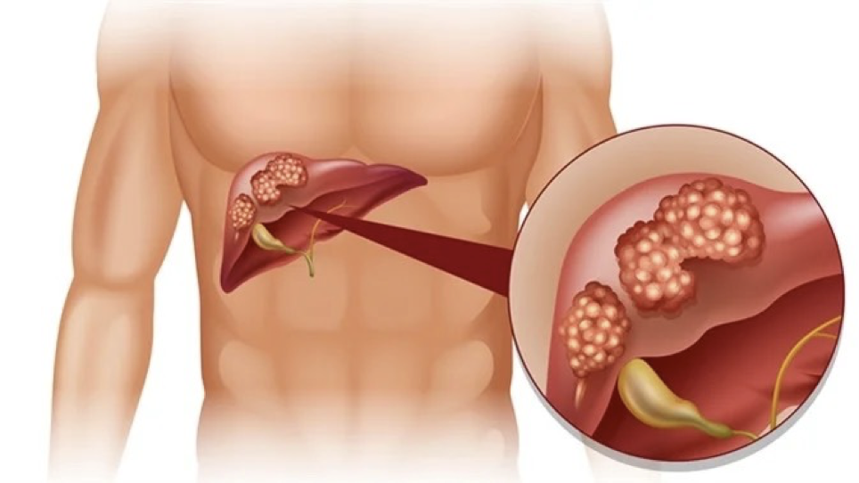 Liver Cancer Treatment- All You Need To Know