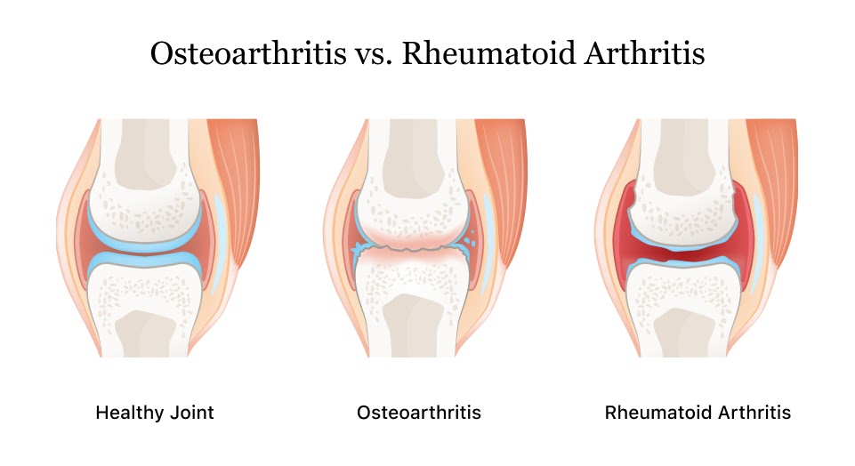 Rheumatoid-arthritis-vs.-osteoarthritis