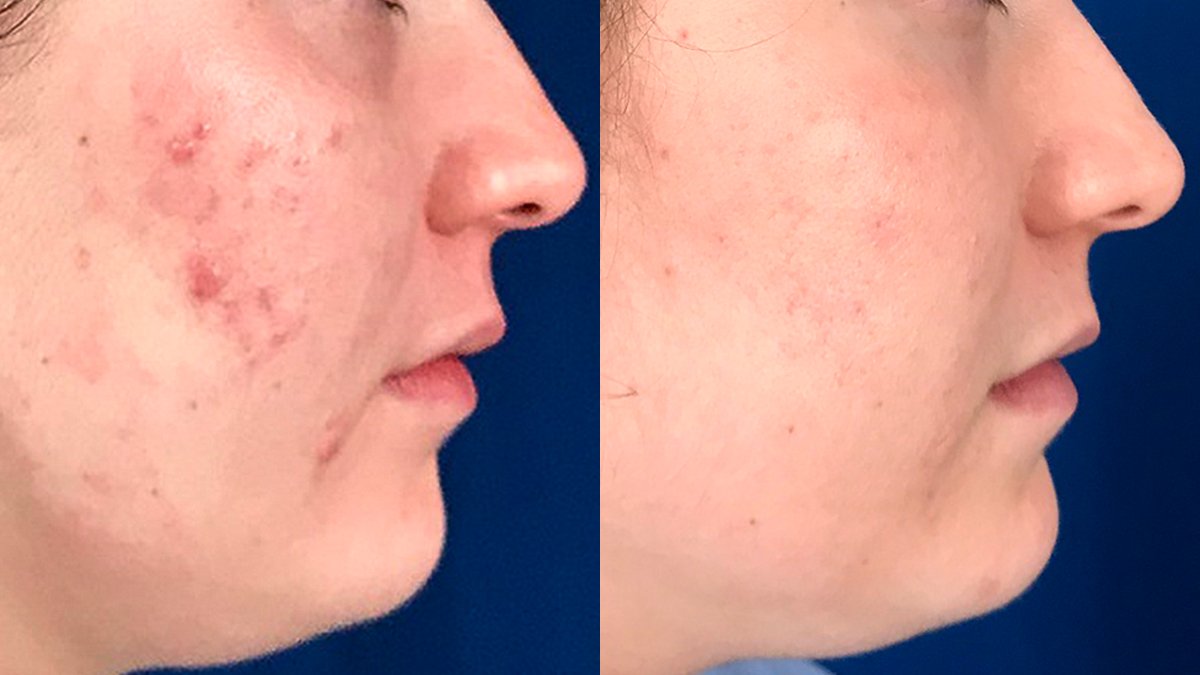 5 Biggest Causes of Acne, Pimple Problem with Best Acne Treatment