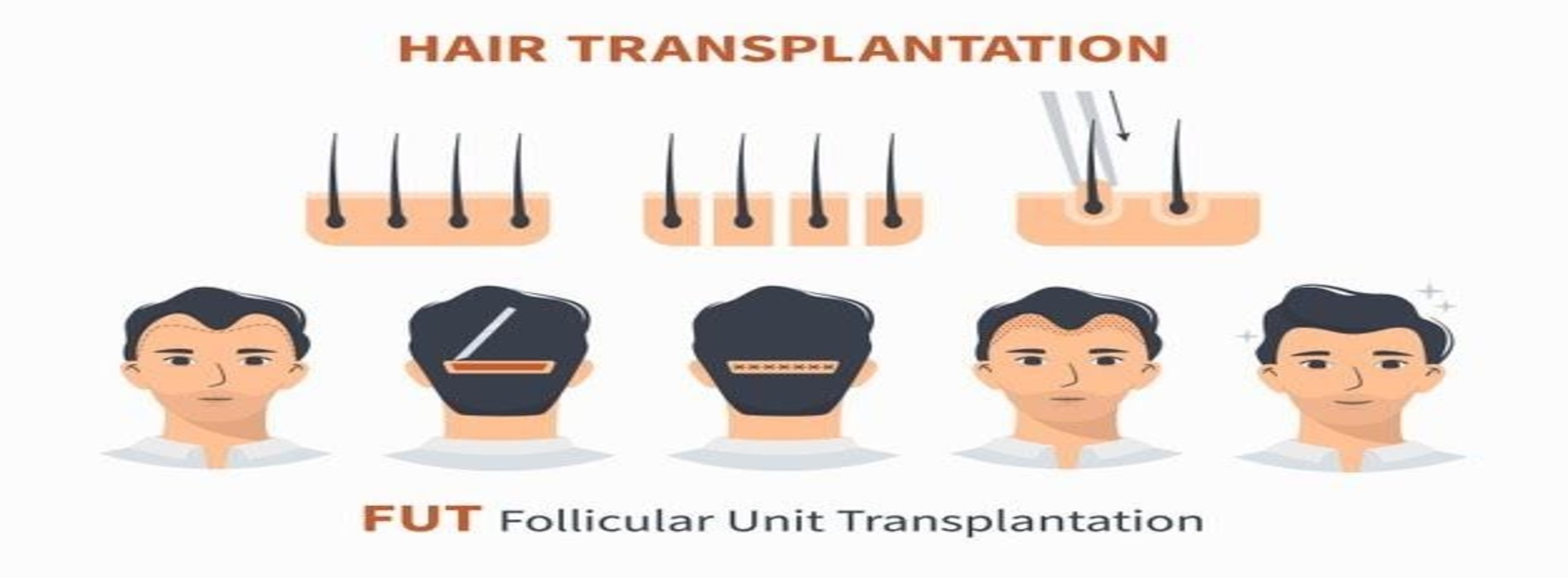 In Jaipur, How Much Does a Hair Transplant Cost?