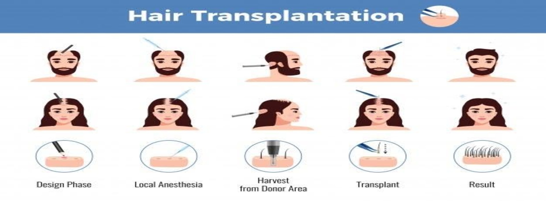 How Much Does Hair Transplant Cost in Hyderabad