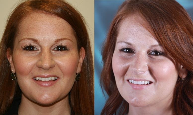 Renew Beauty & Confidence with a Smile Makeover