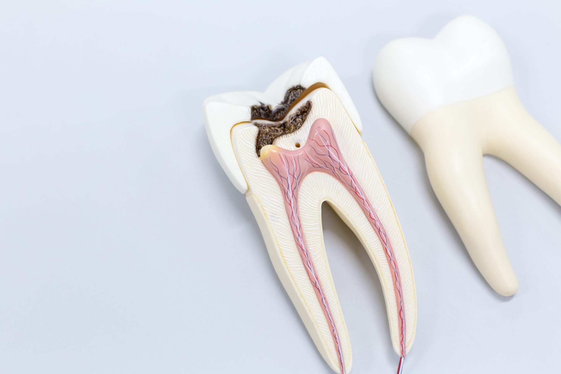 The Before, During, and After of a Root Canal Treatment