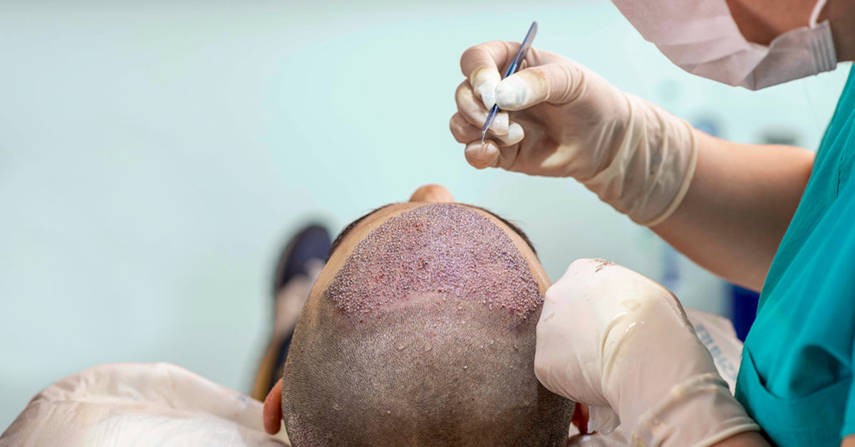 Understand The Cost of Hair Transplants Through Areeva Transplant Centre