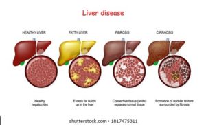 Liver Diseases And Its Symptoms
