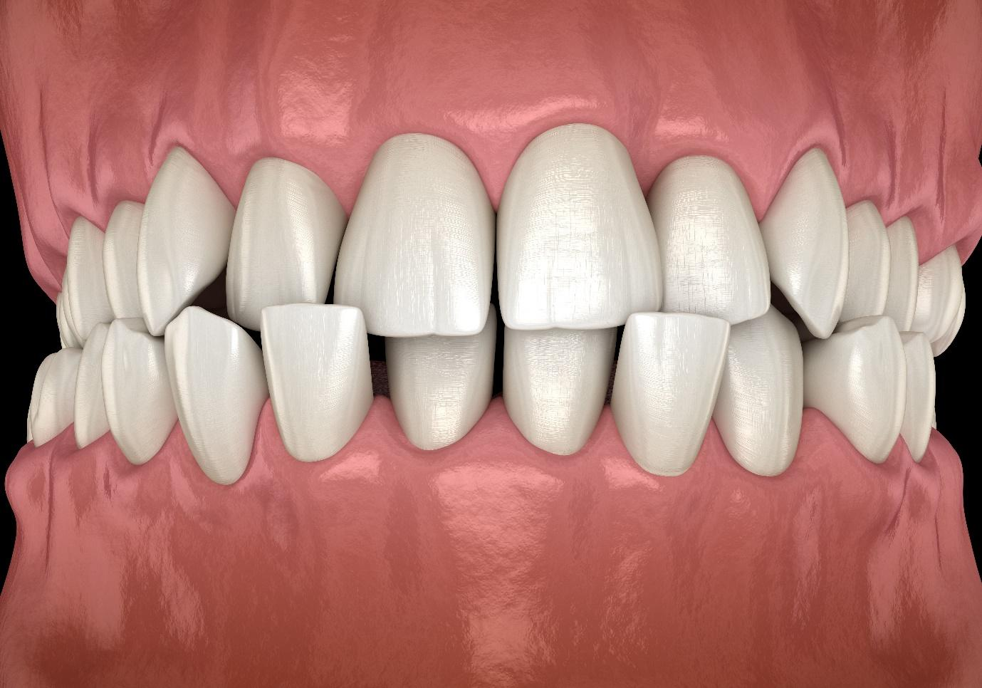 All About Crossbite and How to Correct it With Invisible Braces