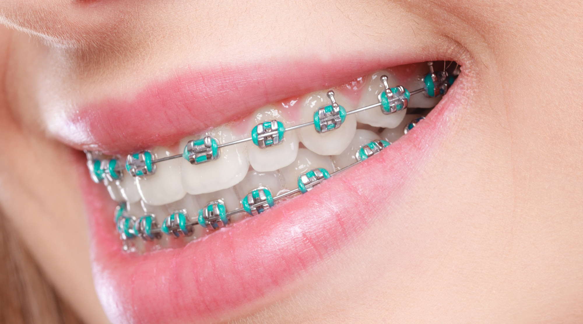 Braces Colors That Look Good On Everyone