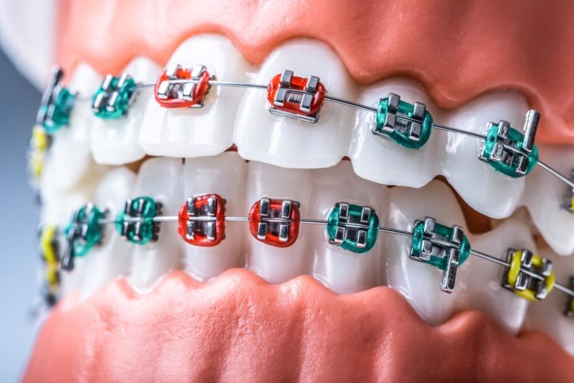 Finding Cheap Orthodontist Near Me for Affordable Braces