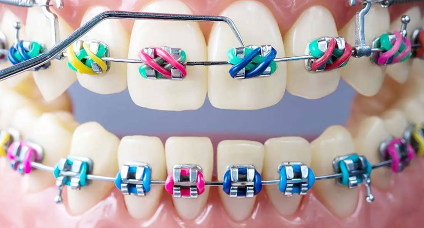 What Braces Colors Make Your Teeth Look White